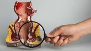 Magnifying glass held by doctor shows model with hemorrhoids.